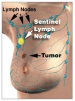 Sentinel Lymph Node